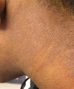 Image result for Eczema On Black Skin with Grey Colour