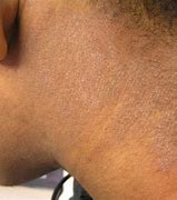 Image result for Eczema On Darker Skin