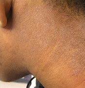 Image result for Eczema On Dark Skin Photos