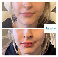 Image result for Versa Lip Filler