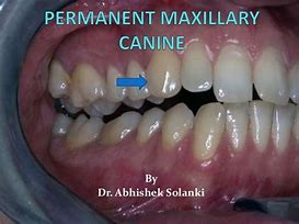 Image result for Maxillary Canine Pulp