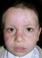 Image result for Fungal Infection On Face Turned Black