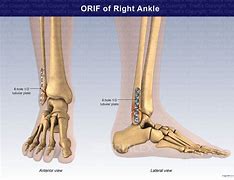 Image result for Orif Hip