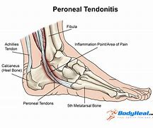 Image result for Peroneal Tendinopathy