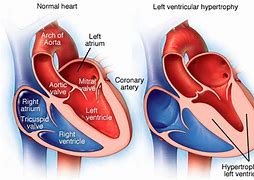 Image result for Ventricular Dilation