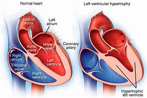 Image result for Right Ventricular Hypertrophy Echo