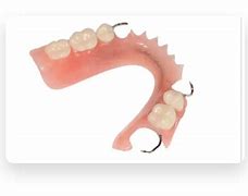 Image result for Acrylic Denture with Wrought Wire Clasps