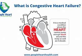 Image result for Congetial Heart Diease Image