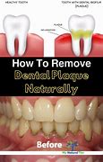 Image result for How to Avoid Plaque On Teeth