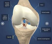 Image result for ACL MCL Meniscus