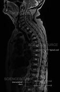 Image result for Imagees Compression Fracture of Lumbar Vertebrae