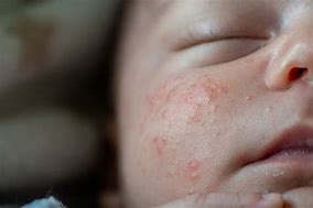 Image result for Eczema On Baby Arm