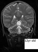 Image result for Ataxia MRI