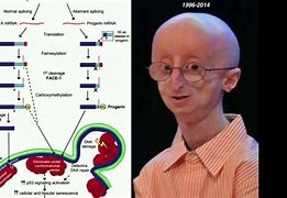 Image result for Progeria