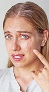 Image result for How to Get Rid Acne Bumps