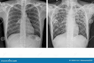 Image result for Chest X-ray of TB