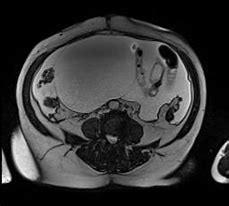 Image result for IRM Abdominale