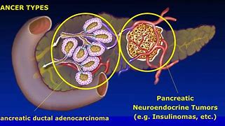 Image result for Pancreatic Adenocarcinoma