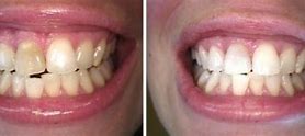 Image result for Root Canal Darkening