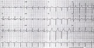 Image result for Heart Failure Electrocardiogram