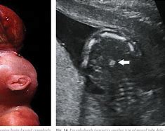 Image result for Anencephaly Ultrasound