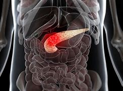 Image result for Pancreatic Cancer