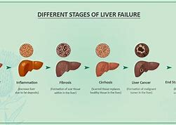 Image result for Early Symptoms Cirrhosis Liver