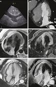 Image result for Interatrial Septum Lipomatous Hypertrophy Echo