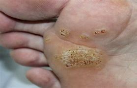 Image result for Plantar Wart Duct Tape