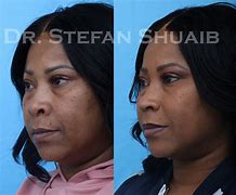 Image result for African American Rhinoplasty