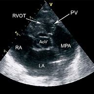 Image result for Rvot Heart Anatomy