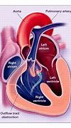 Image result for Anatomical Site of Left Ventricular Outflow Tract