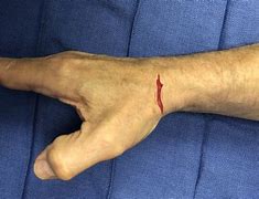 Image result for Wrist Laceration