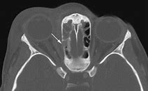 Image result for Subperiosteal Abscess Orbital Cellulitis