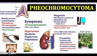 Image result for 5 Ps of Pheochromocytoma