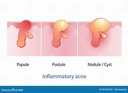 Image result for Papule Pimple