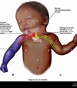 Image result for Brachial Plexus Injury