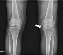 Image result for Hip Joint Space Narrowing