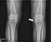 Image result for Patellofemoral Joint Space Narrowing