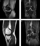 Image result for Tear of Meniscus