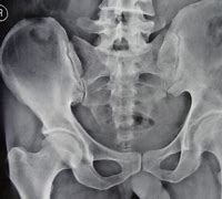 Image result for Bone Metastases