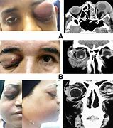 Image result for Subperiosteal Abscess Orbital Cellulitis