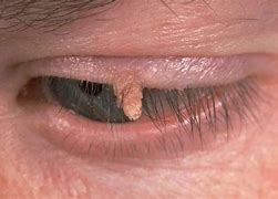 Image result for Flat Warts On Eyelids