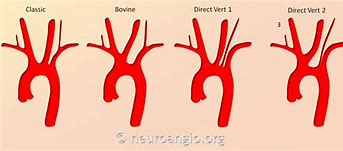 Image result for 3 Branches of Aortic Arch