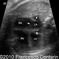 Image result for Septal Aneurysm