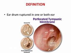 Image result for Tympanic Perforation