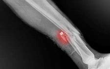 Image result for Avulsion Fracture