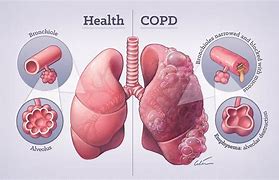 Image result for Asthma and COPD 3D Figures