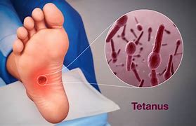 Image result for Tetanus Patient