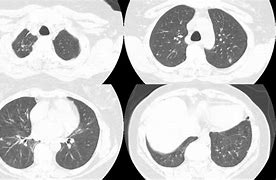 Image result for Multiple Lung Nodules